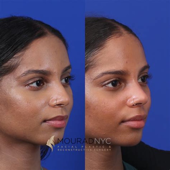 Casemiro Plastic Surgery: Nose Job Before And After Photos
