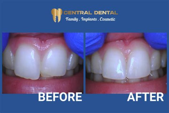 What Happened To Eliza Isichei Tooth? Before And After Photos